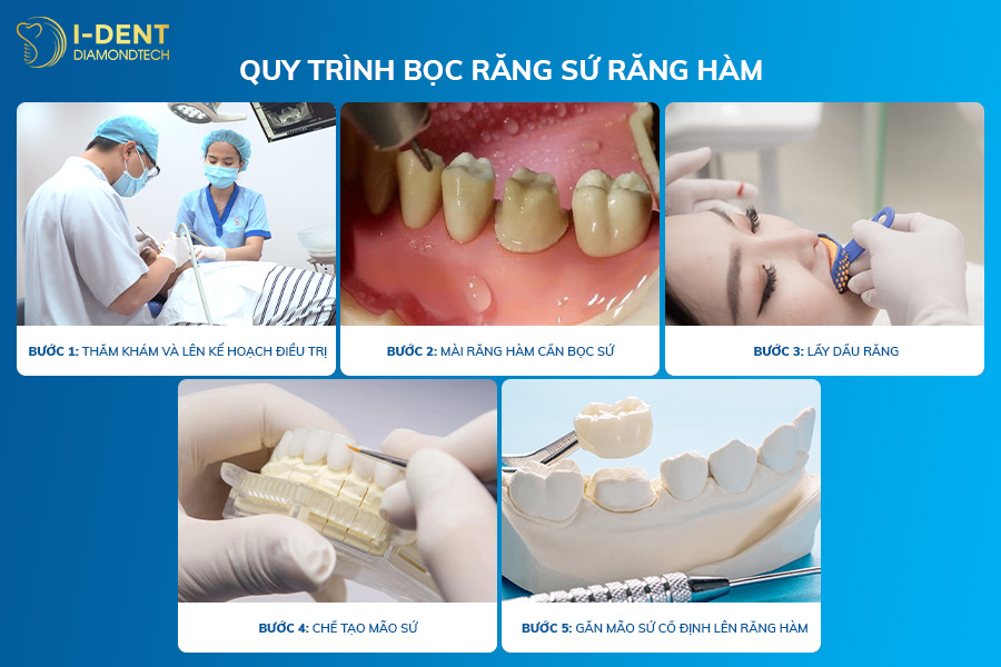 bọc sứ răng nhai