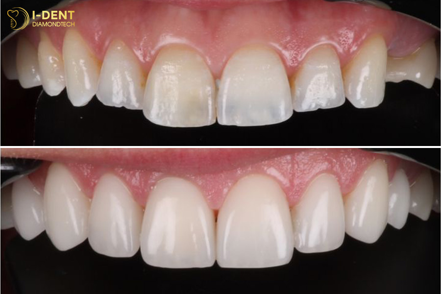chia sẻ kinh nghiệm dán răng sứ veneer