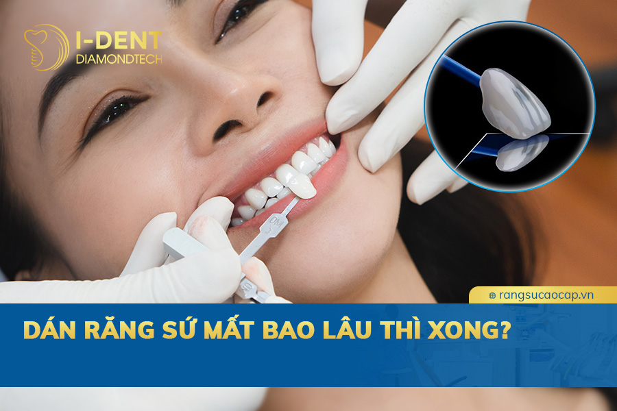 dán răng sứ mất bao lâu