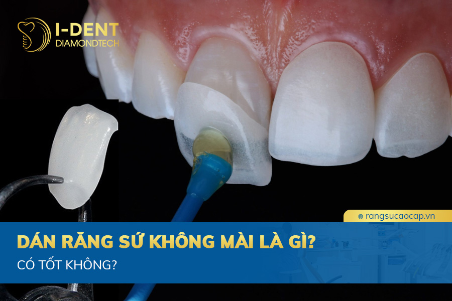 dán sứ có cần mài răng không