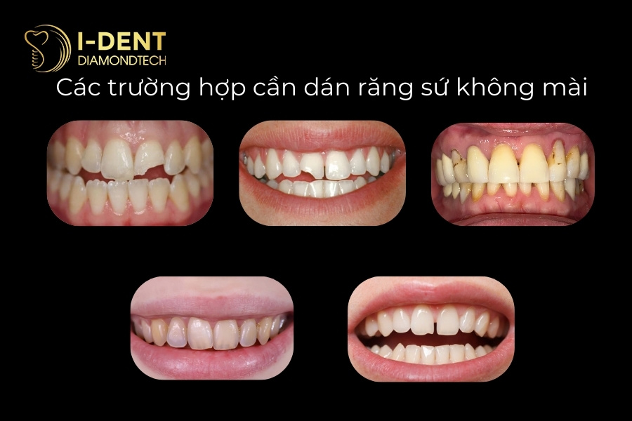 dán sứ có phải mài răng