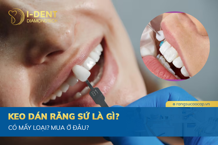 keo dán răng sứ vĩnh viễn