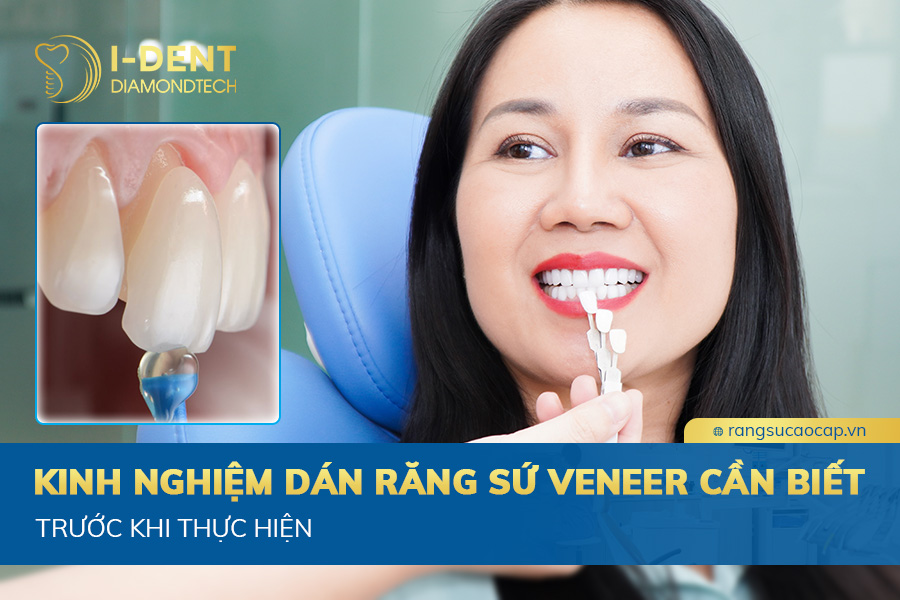 kinh nghiệm dán răng sứ veneer
