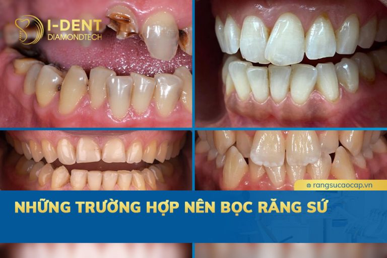 những trường hợp nên bọc răng sứ