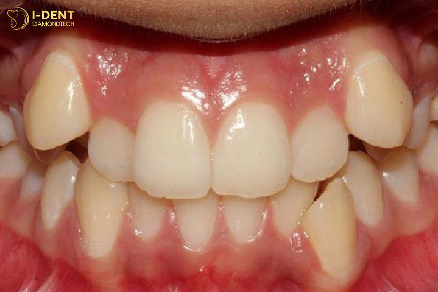 răng khấp khểnh có nên bọc sứ