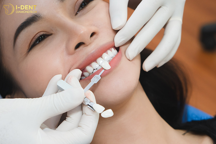 thời gian hoàn thiện dán sứ veneer
