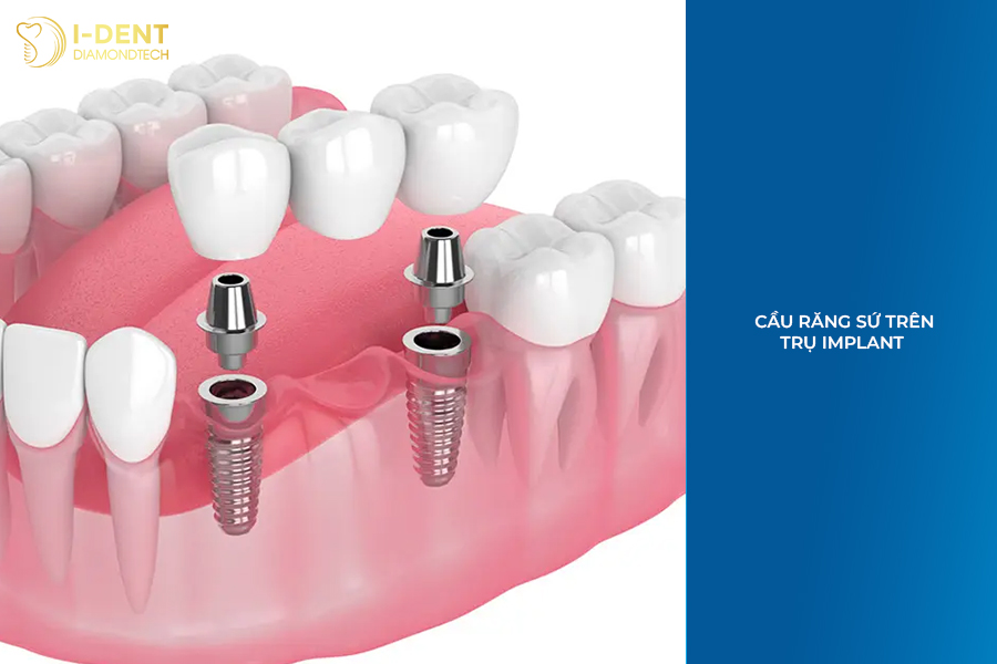 bắc cầu răng sứ có bền không