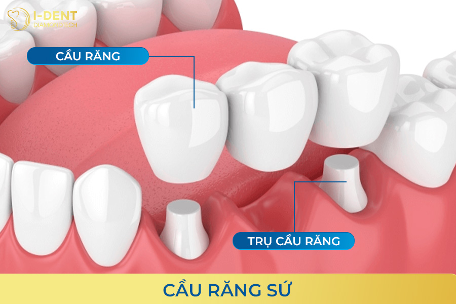 bắc cầu răng sứ