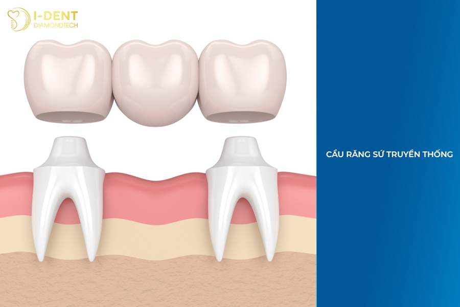 bắt cầu răng sứ