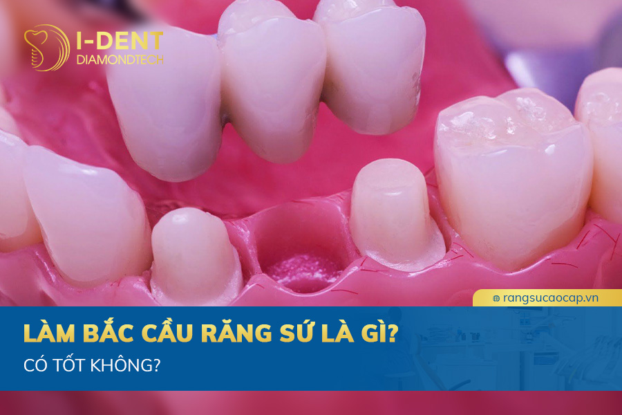 cầu răng sứ