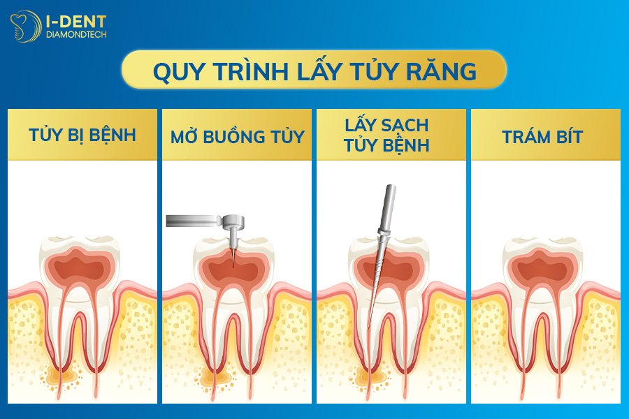 điều trị tủy răng có nên bọc sứ