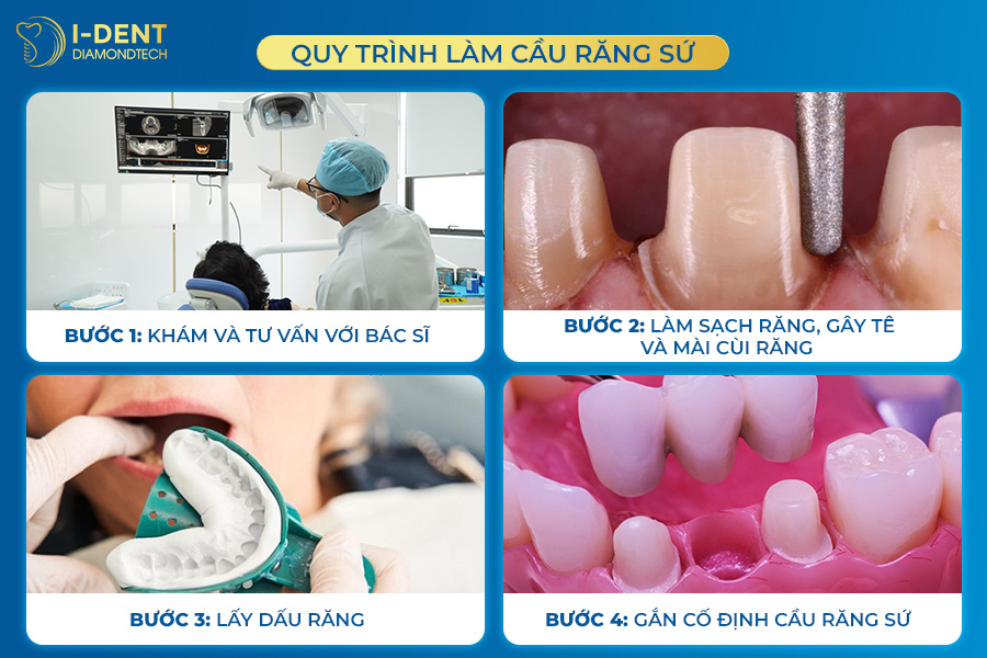 làm cầu răng sứ có tốt không