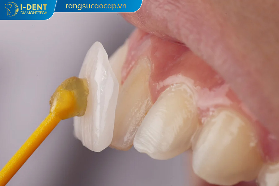 công nghệ bọc răng sứ không mài