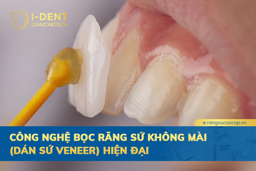 công nghệ bọc răng sứ